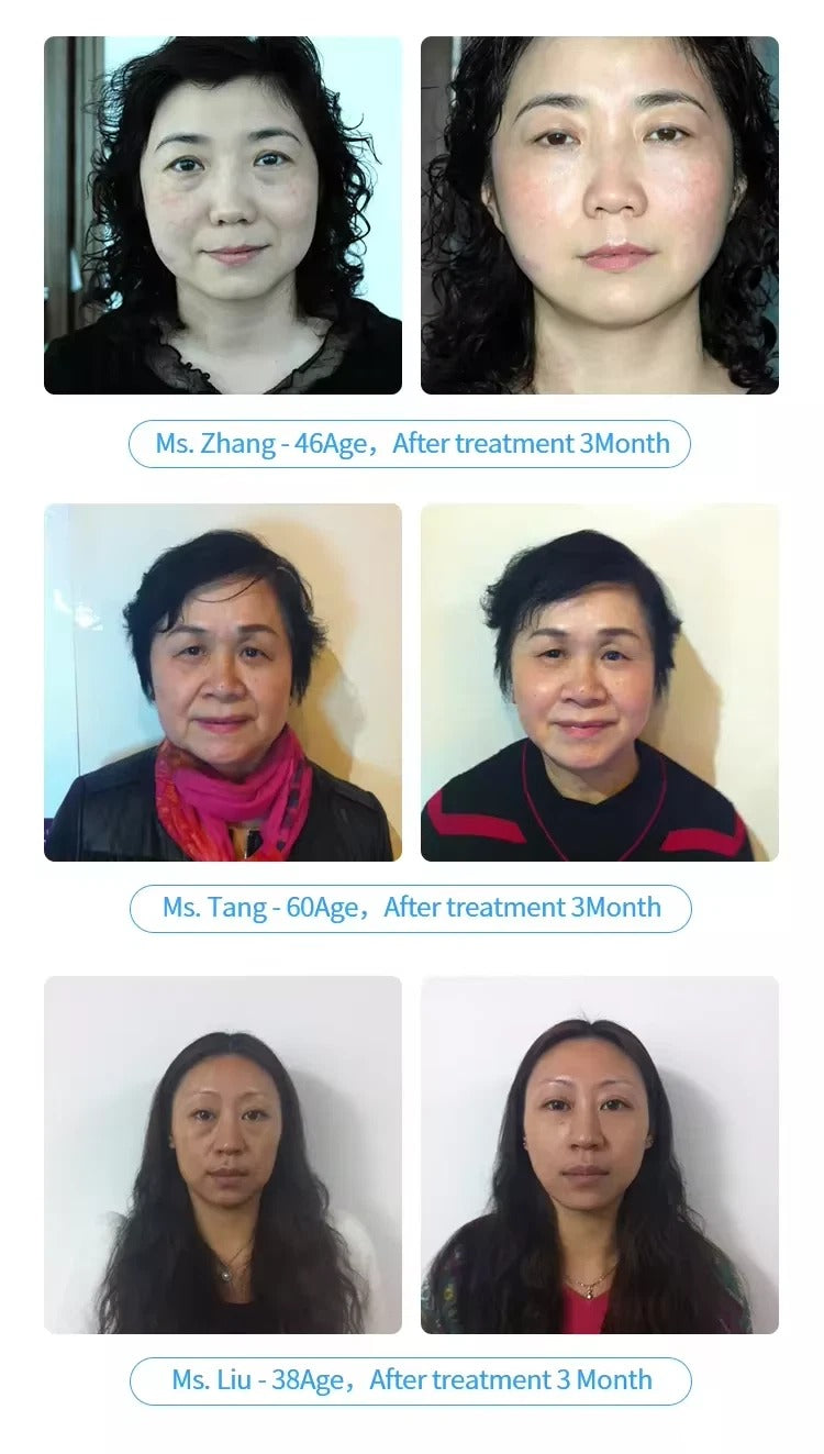 Portable RF Skin Tightening Machine