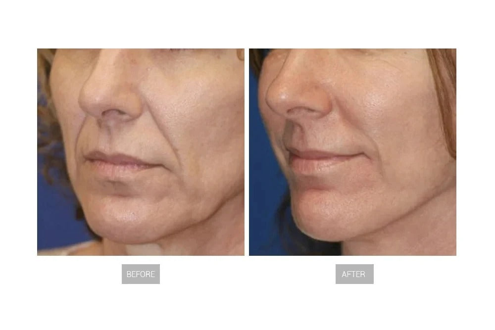 EMS Face Lifting Machine Facial Muscle Sculpting Skin Tightening Device